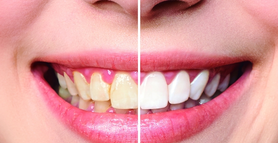 Odontologia estética: Você já ouviu falar sobre faceta?