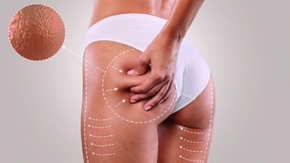 6 suplementos para acabar com a celulite