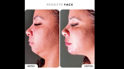 Procedimentos estéticos faciais ajudam a controlar o envelhecimento