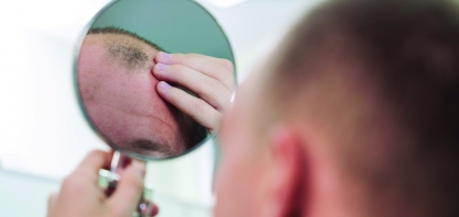 Calvície masculina: quais são os sinais de alerta?
