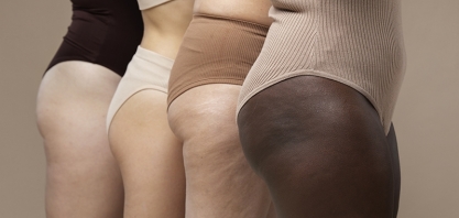 SAÚDE FEMININA  - Lipedema impacta a saúde vascular de aproximadamente 10% das brasileiras