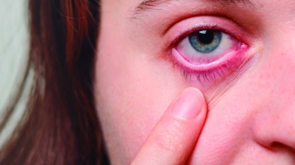 Incidência de conjuntivite viral aumenta 12% de um ano para o outro